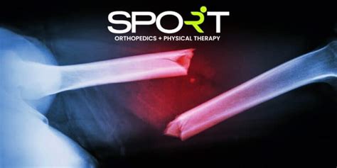 Displaced Fracture Treatment | SPORT Orthopedics | Dallas, TX