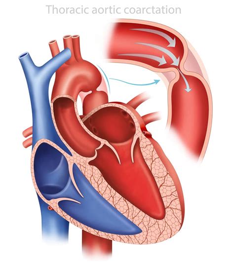 Coarctation Of The Aorta In Infants: Causes And Treatment