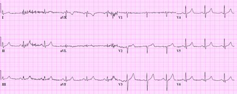 Dr. Smith's ECG Blog: Is this acute coronary occlusion? Simple ACS? Where is the culprit lesion?