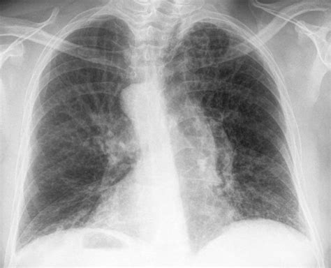 Mild Cylindrical Bronchiectasis: Comprehensive Guide to Treatment, Symptoms, and Prognosis