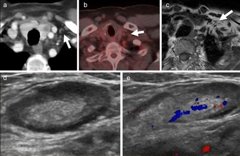 Supraclavicular Lymph Node Ultrasound