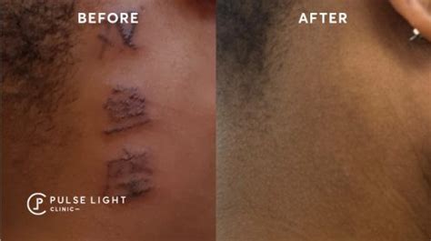 Update more than 66 laser tattoo removal black skin - in.cdgdbentre