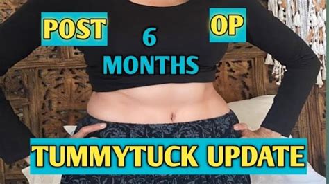 TUMMY TUCK POST OP 6 MONTHS UPDATE// SCAR REVEIW BEFORE AND AFTER PICS ...