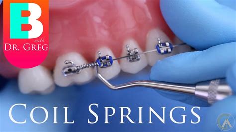 [BRACES EXPLAINED] Coil Springs - YouTube