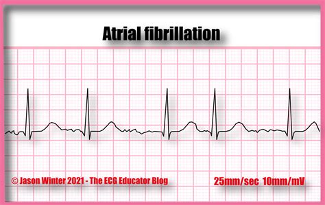 Afib Ekg Rhythm Strip | Sexiz Pix