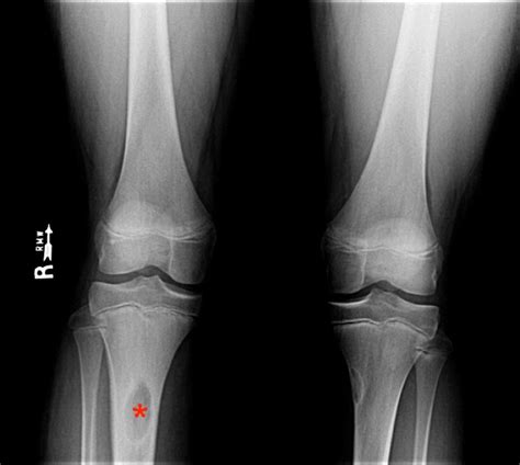 Osteomyelitis X Ray Features