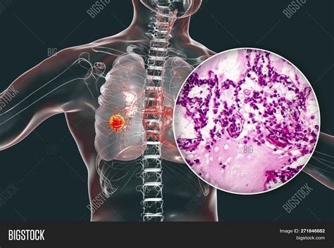 Lung Cancer, 3d Image & Photo (Free Trial) | Bigstock