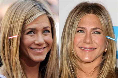 Has Jennifer Aniston Had Plastic Surgery? (Before & After 2018)