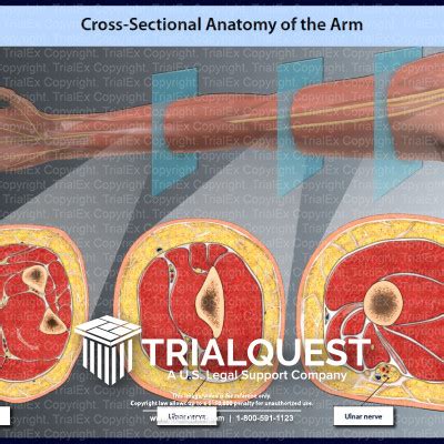 Cross-Sectional Anatomy of the Arm - TrialExhibits Inc.