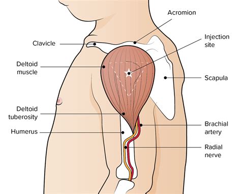 Figure. Anatomical markers used to identify the deltoid injection site ...