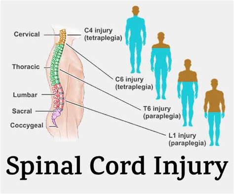 SPINAL CORD INJURY (SI) Free Trial - Pass The OT