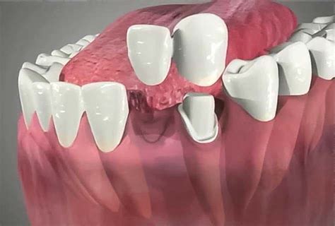 What is a Cantilever Dental Bridge?