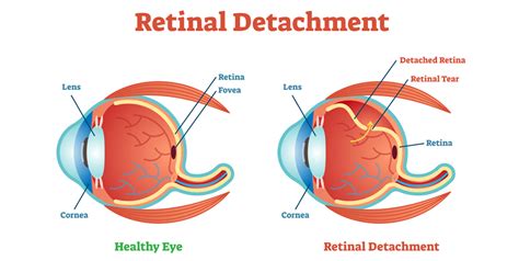 Describe What Happens When a Retinal Detachment Occurs - Titus-has-Mosley