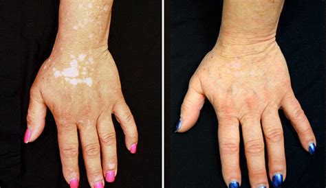 For vitiligo patient, arthritis drug restores skin color | YaleNews