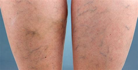 Benefits of IPL for Spider Veins | Advanced Dermatology Care