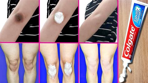 How To Get Rid Of Dark Elbows Overnight : Check out what causes dark ...