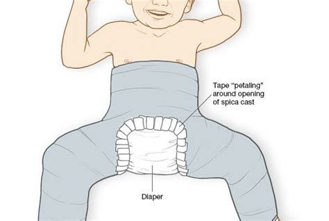 Hip dysplasia – diagnosis and treatment – Healthy Food Near Me