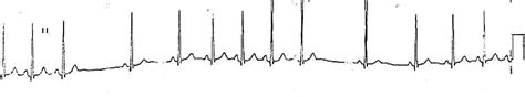 Sinoatrial Exit Block • LITFL • ECG Library Diagnosis