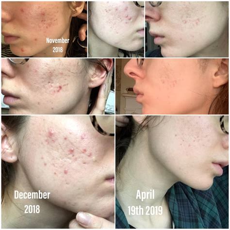 My journey (thus far) with active acne and hyperpigmentation/deep scars ...