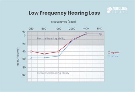 Low Frequency Hearing Loss: Symptoms and Treatment - Audiology Island