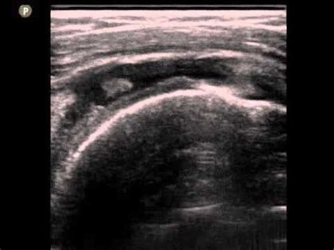 Supraspinatus Ultrasound