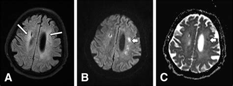 Cytomegalovirus encephalitis: a 32-year-old man diagnosed with ALL ...