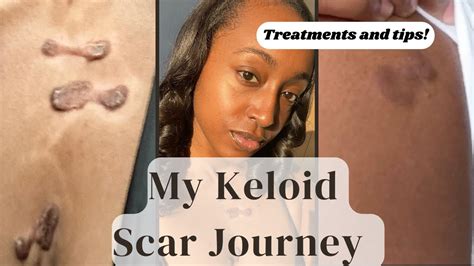 My Keloid Scar Journey! | What treatments have I done?| Surgery ...