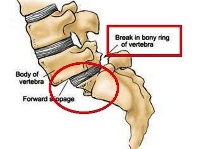 What is Anterolisthesis? Grading 1234, Treatment, Causes