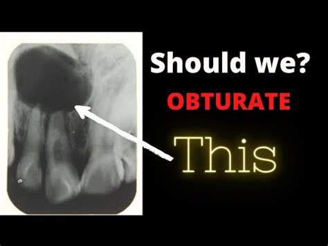 Should we Obturate tooth with periapical Radiolucency? |Dental ji - YouTube