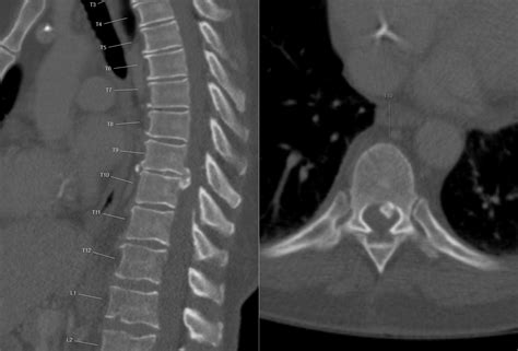 Calcified Thoracic Disc Herniation