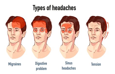 Headache Types Symptoms Causes And Treatment - vrogue.co