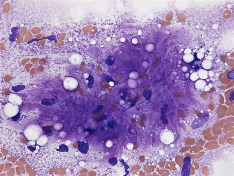 Myxoid liposarcoma, microscopy | Wellcome Collection