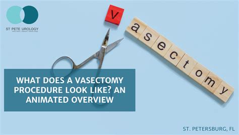 What Does a Vasectomy Procedure Look Like? An Animated Overview | St ...