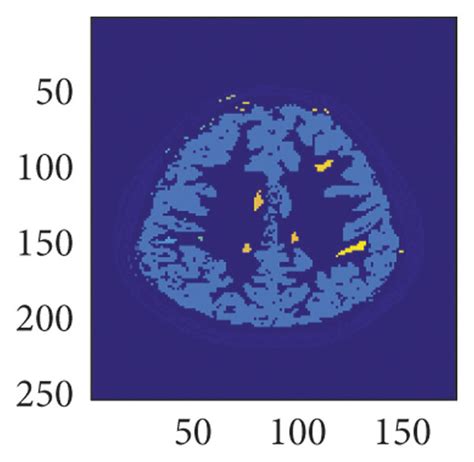 Fully automatic gray and white matter segmentation in brain MRI images... | Download Scientific ...