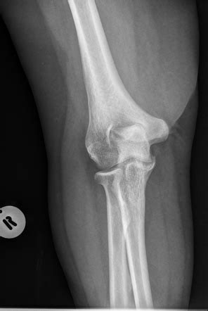 Coronoid process fracture | Radiology Case | Radiopaedia.org