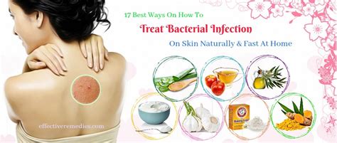 17 Best Ways How To Treat Bacterial Infection On Skin At Home