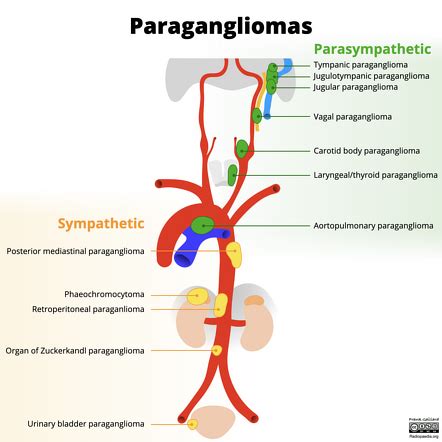 Paraganglioma | Radiology Reference Article | Radiopaedia.org