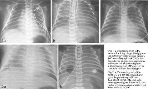 Surfactant protein B deficiency: radiographic manifestations | Semantic Scholar