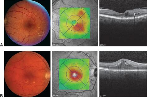 Diabetic macular edema - American Academy of Ophthalmology