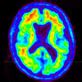 San Francisco VA Neurodegenerative Disease Imaging | UCSF Radiology