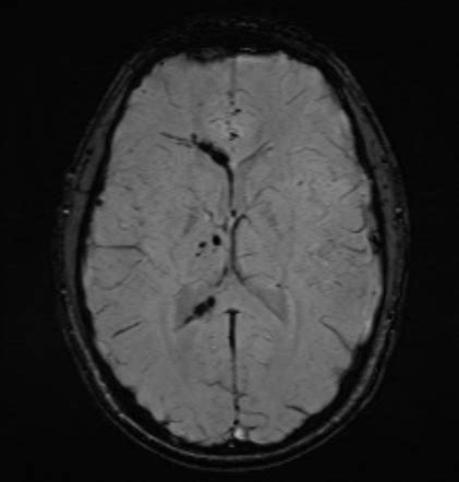 Diffuse axonal injury (grading) | Radiology Reference Article ...