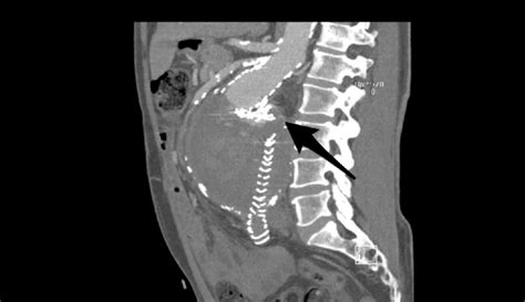 Post-procedure 62-month CT-scan depicting a large, type III endoleak ...