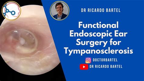 Functional endoscopic ear surgery for tympanosclerosis - YouTube