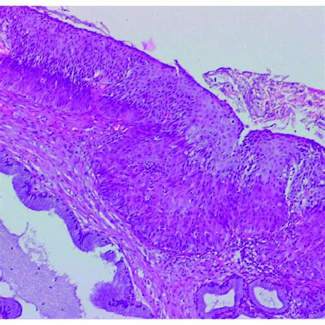 Colposcopic mage of a low-grade LSIL PAP smear. At the border of the ...