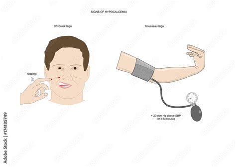 Obraz Two neurological test to evaluate the presence of hypocalcemia ...