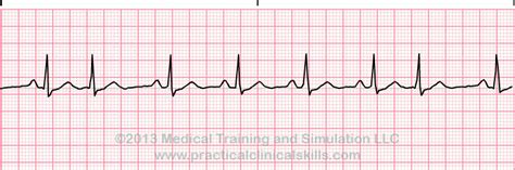 Premature Junctional Complex EKG Interpretation with Rhythm Strip