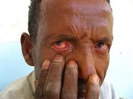 Health Info93: What is Trachoma: Causes, Prevention, and Treatment