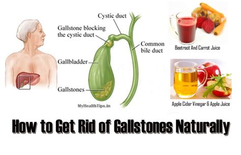 How To Dissolve Gallstones Naturally : Dissolve gallstones naturally 5 most effective ways ...