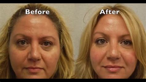 Filler For Marionette Lines Before And After | Thebrokensealblog