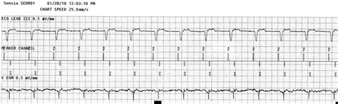 Surface ECG shows retrograde P waves. Intracardiac markers show Ap-Vs. | Download Scientific Diagram